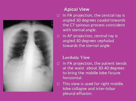 what is apicolordotic view in tagalog|Chest X.